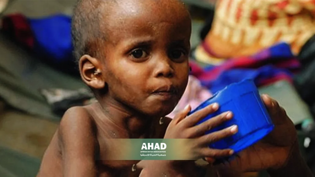 Sudanese Children and Acute Malnutrition